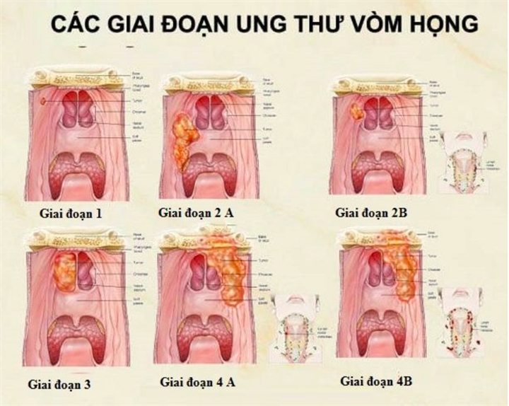 Ung thư vòm họng: Triệu chứng sớm nhất là gì, cách điều trị ra sao? - 2